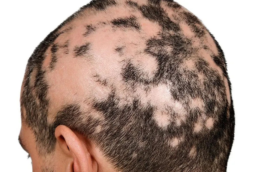 Hair loss_alopecia areata