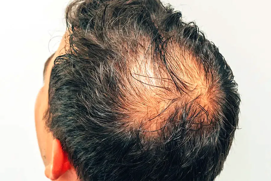 Hair loss_androgenetic alopecia (aga)