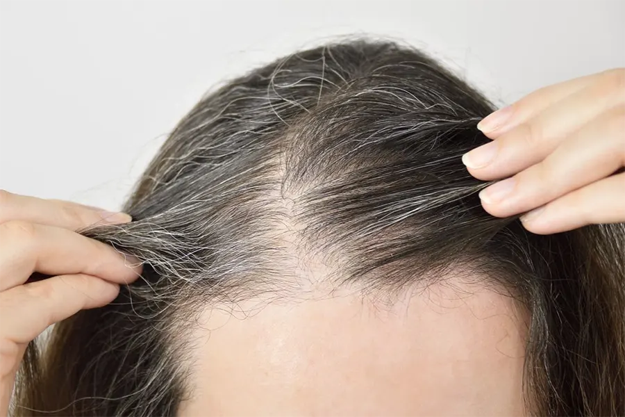 Hair loss_telogen effluvium