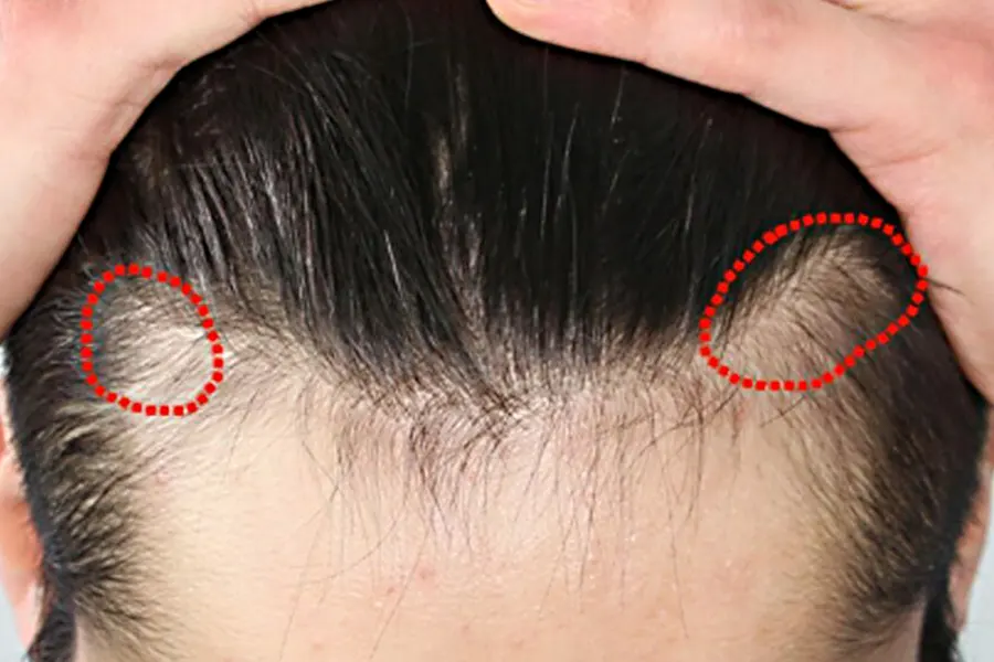 Hair loss_traction alopecia