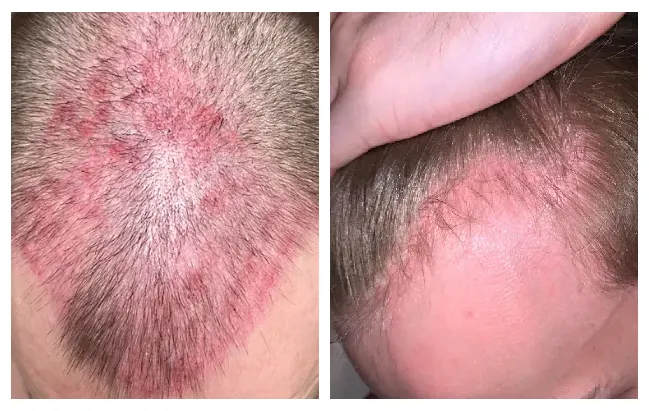 Microneedling cause skin redness or scalp bleeding