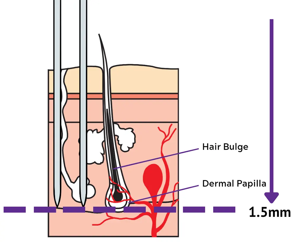 Needle length for hair growth