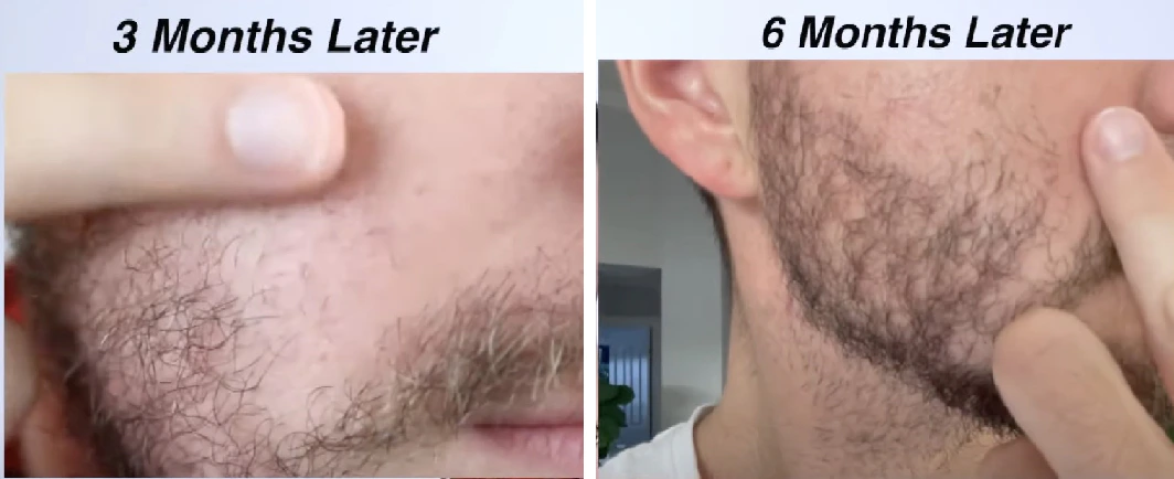 Beard-rolling-results-after-3-and-6-months. Jpg