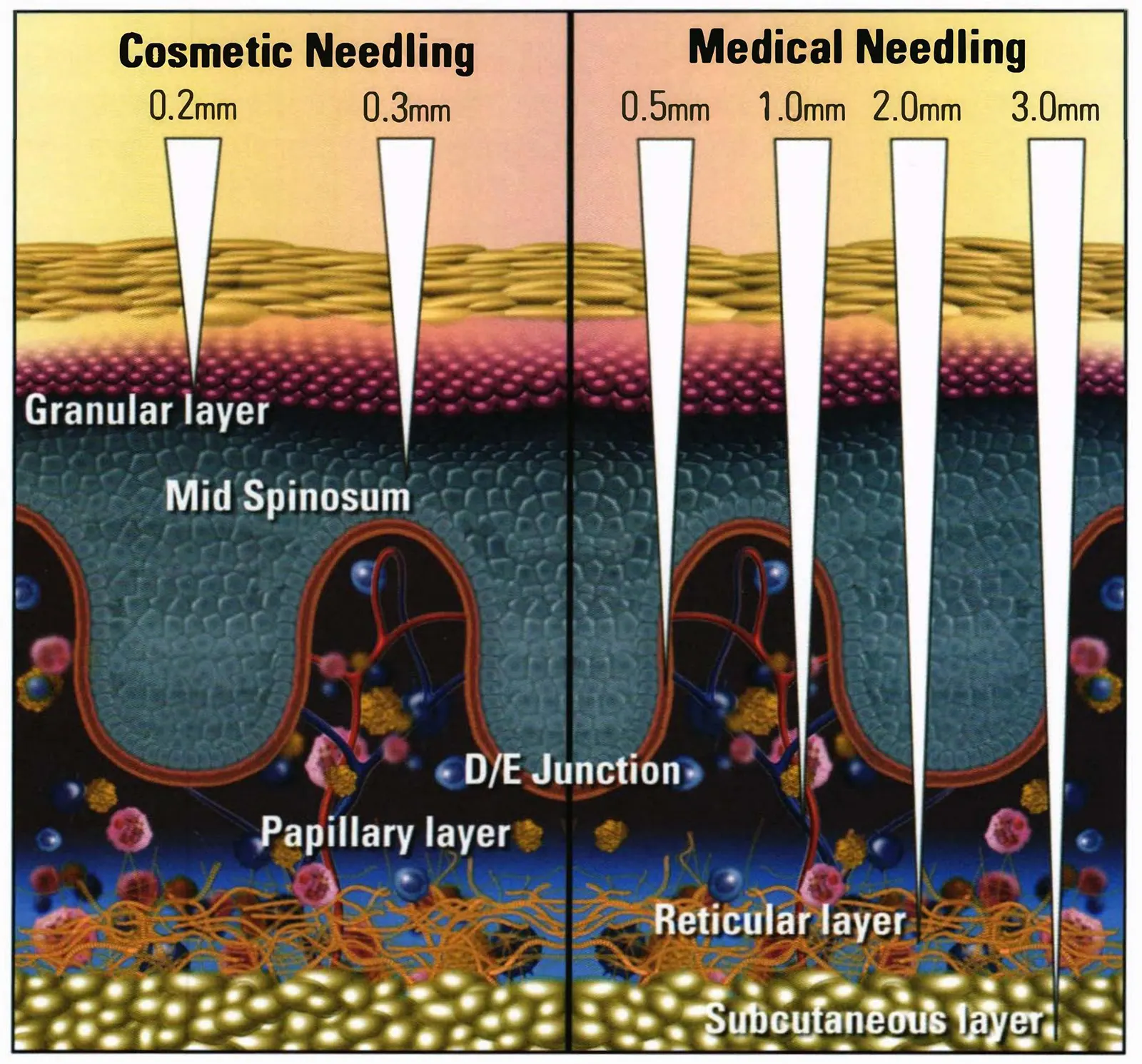 Diagram of the needling depth of cosmetic microneedling and medical microneedling