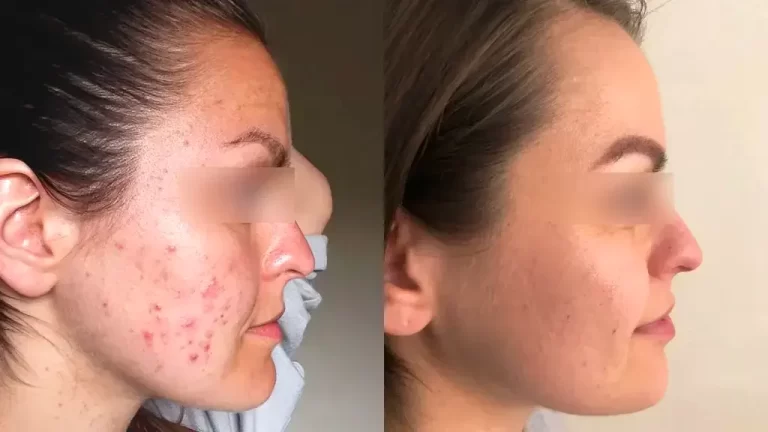 High frequency wand for acne