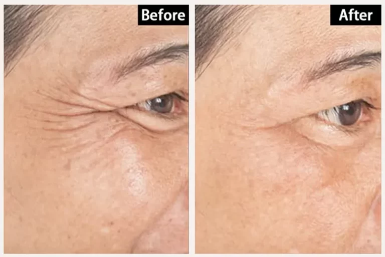 High frequency wand for wrinkles